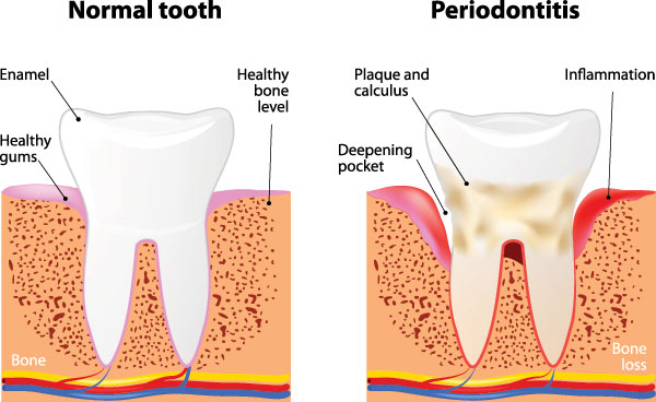 Periodontal (Gum) Disease Jacksonville