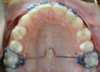 Lowered Lingual Holding Arch